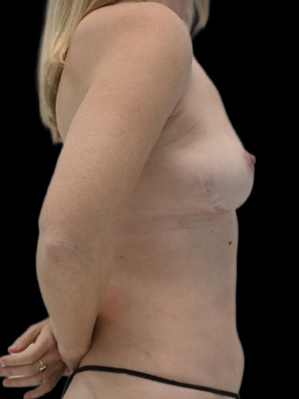 LAP Flap Surgery Before & After Image