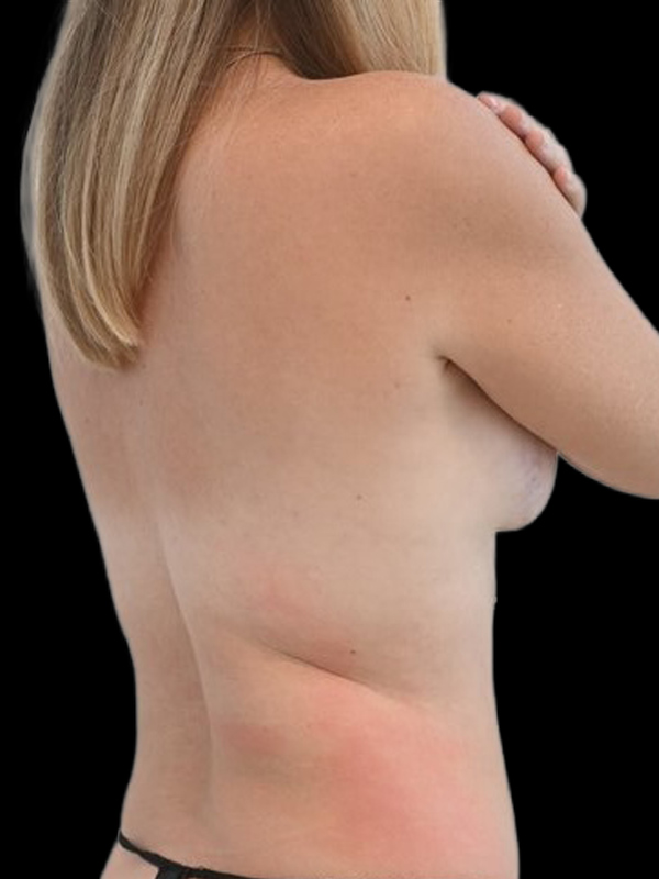 LAP Flap Surgery Before & After Image