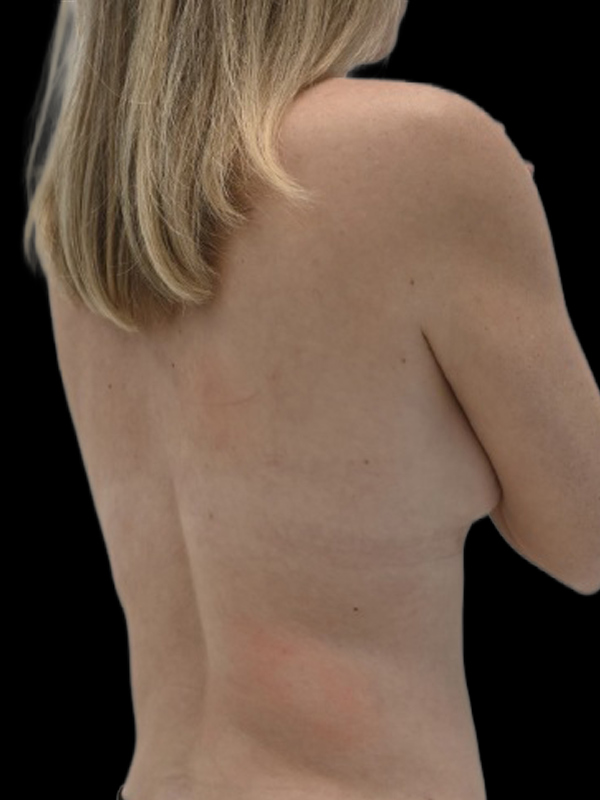 LAP Flap Surgery Before & After Image