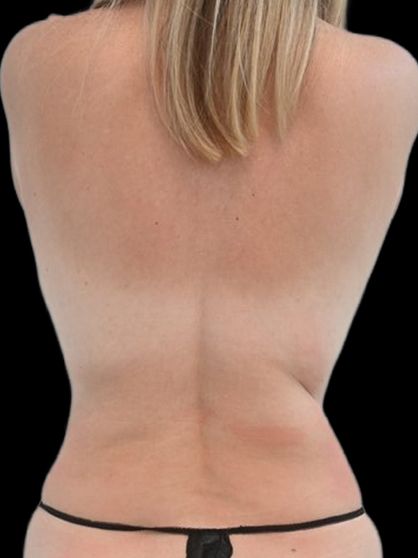 LAP Flap Surgery Before & After Image