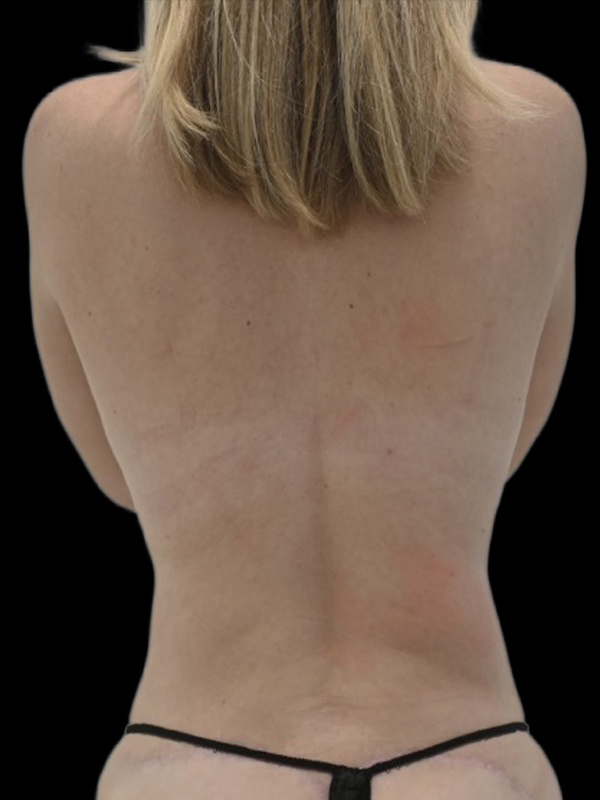 LAP Flap Surgery Before & After Image