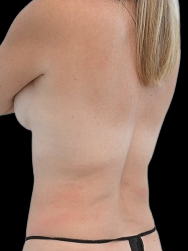 LAP Flap Surgery Before & After Image