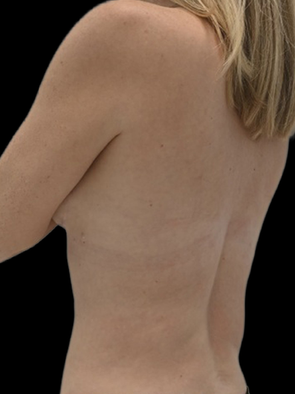 LAP Flap Surgery Before & After Image