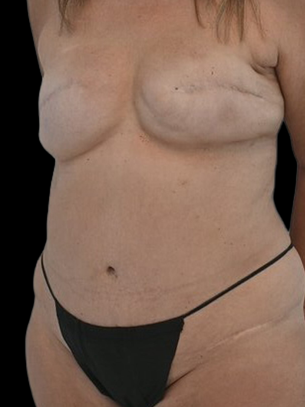 LAP Flap Surgery Before & After Image