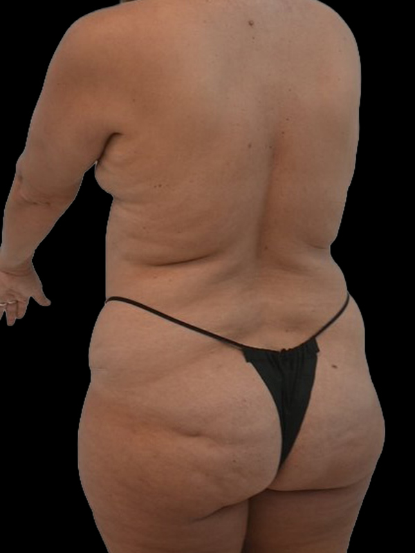 LAP Flap Surgery Before & After Image