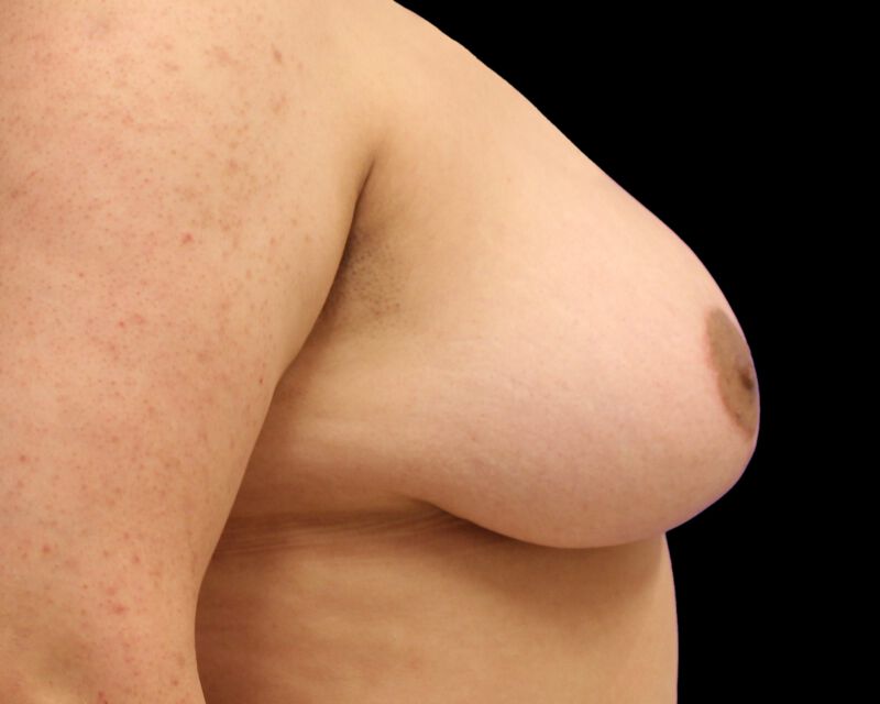 Mastopexy Before & After Image