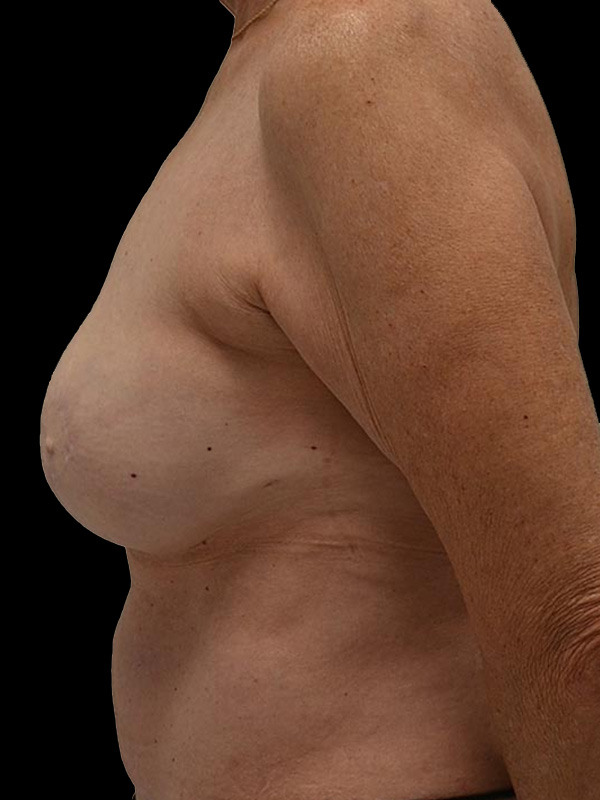 Nipple Reconstruction Before & After Image