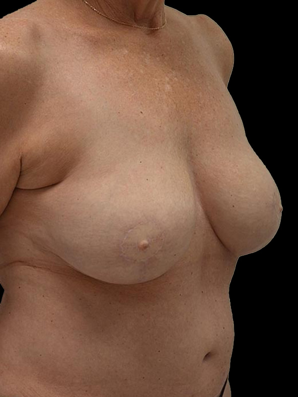 Nipple Reconstruction Before & After Image