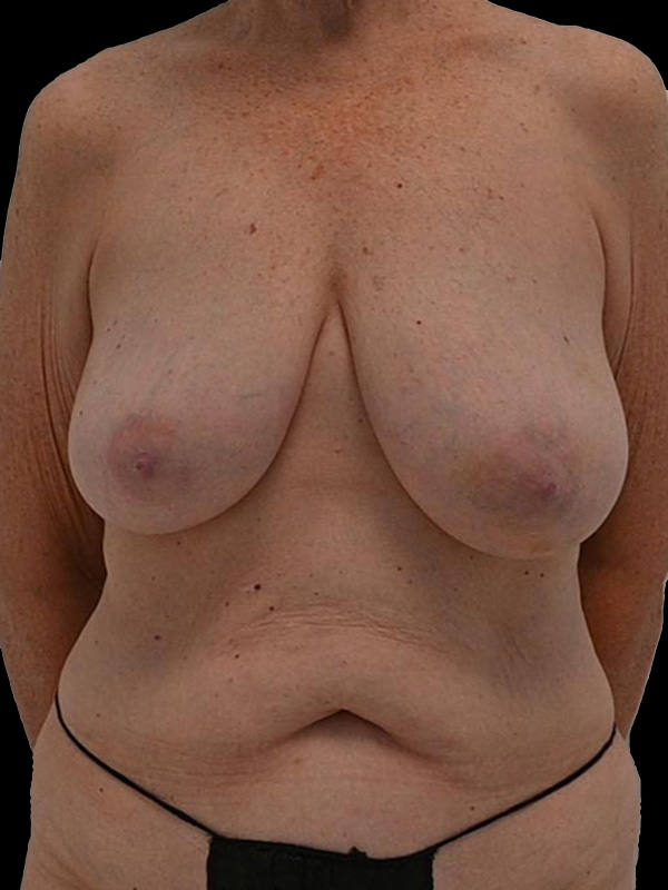 Nipple Reconstruction Before & After Image