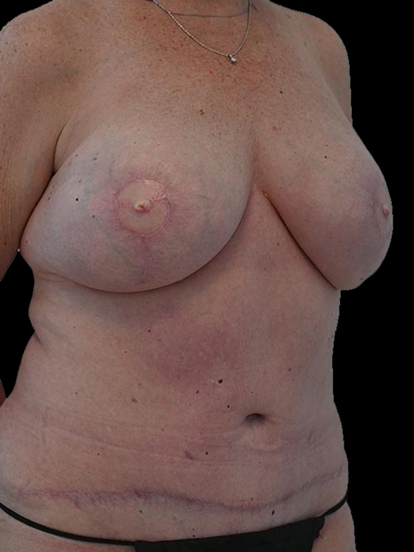 Nipple Reconstruction Before & After Image