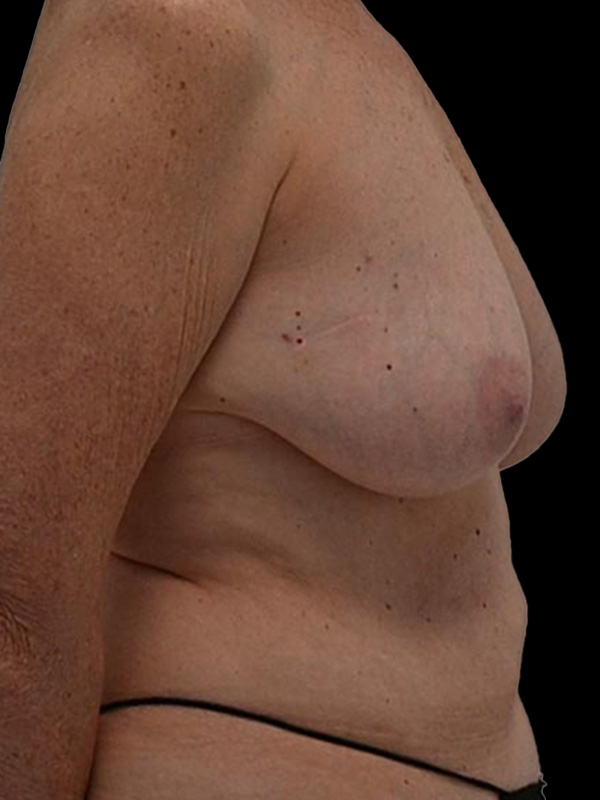 Nipple Reconstruction Before & After Image