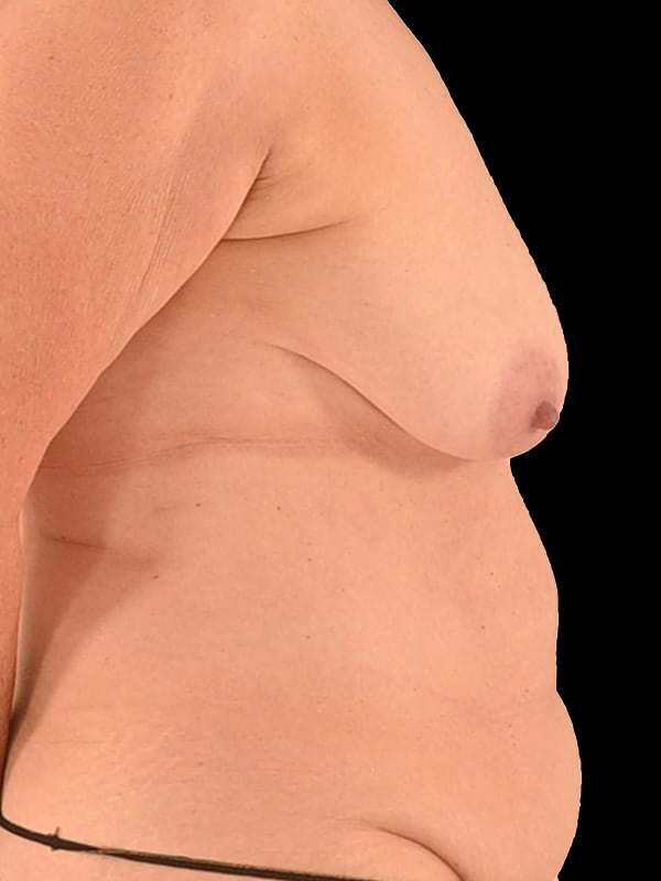 Nipple Reconstruction Before & After Image