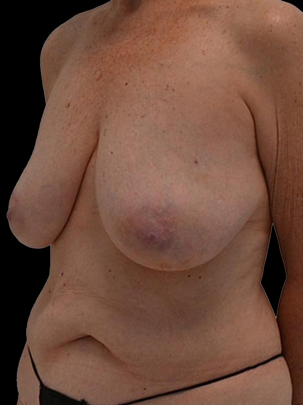 Nipple Reconstruction Before & After Image