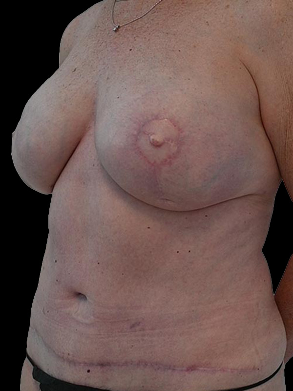 Nipple Reconstruction Before & After Image