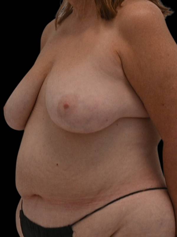 Nipple Reconstruction Before & After Image