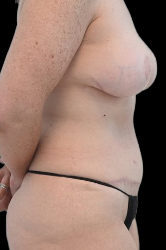 Nipple Reconstruction Before & After Image