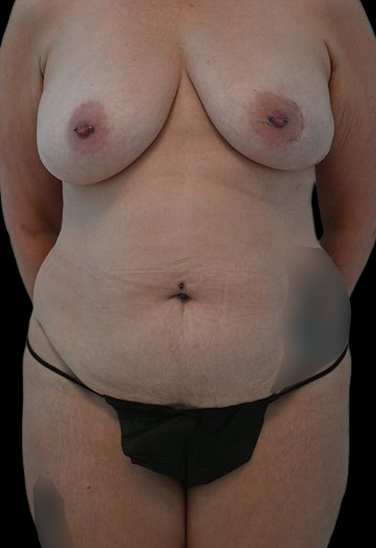 Nipple Reconstruction Before & After Image