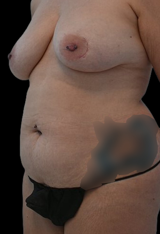 Nipple Reconstruction Before & After Image