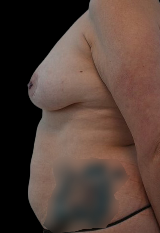 Nipple Reconstruction Before & After Image