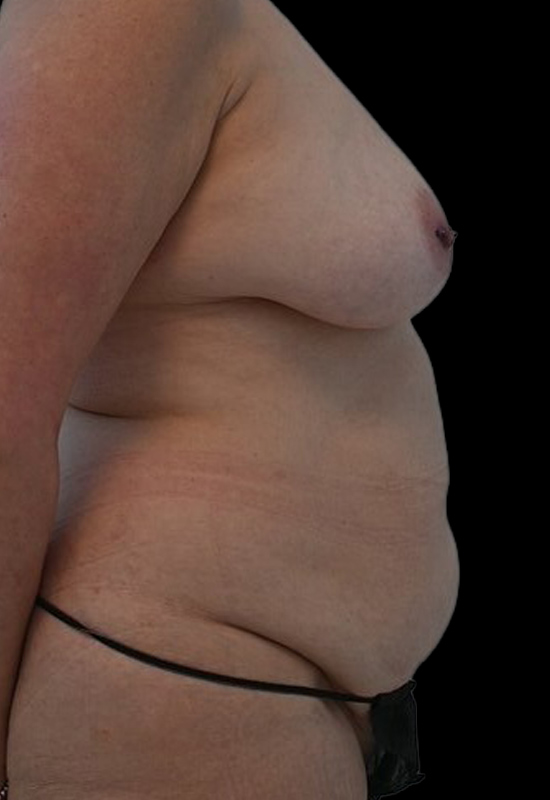 Nipple Reconstruction Before & After Image