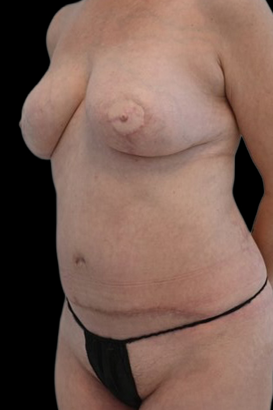 Nipple Reconstruction Before & After Image