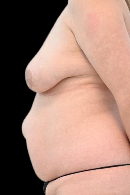 Nipple Reconstruction Before & After Image