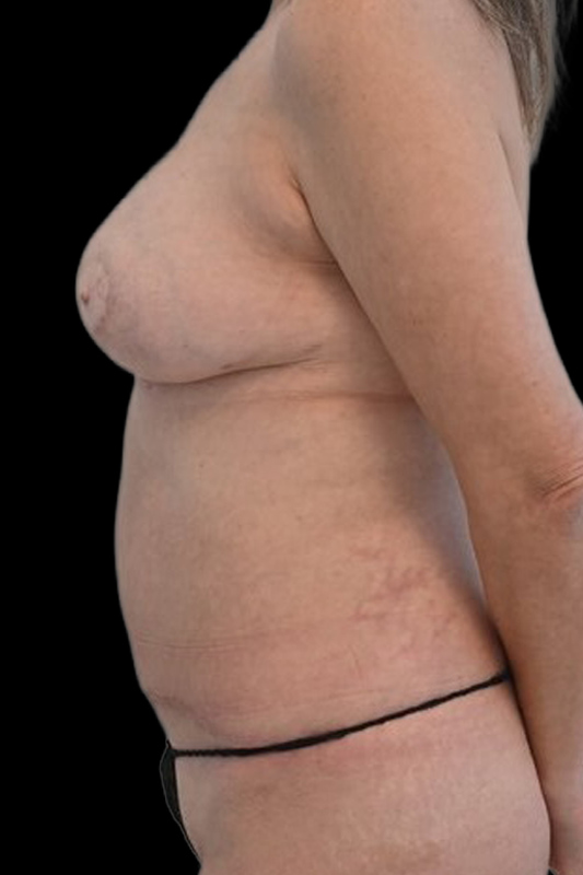 Nipple Reconstruction Before & After Image