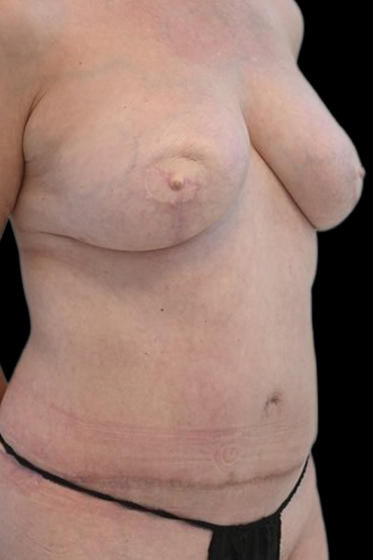 Nipple Reconstruction Before & After Image