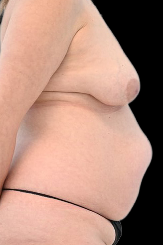 Nipple Reconstruction Before & After Image