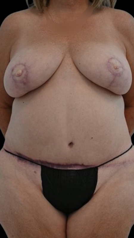 Nipple Reconstruction Before & After Image
