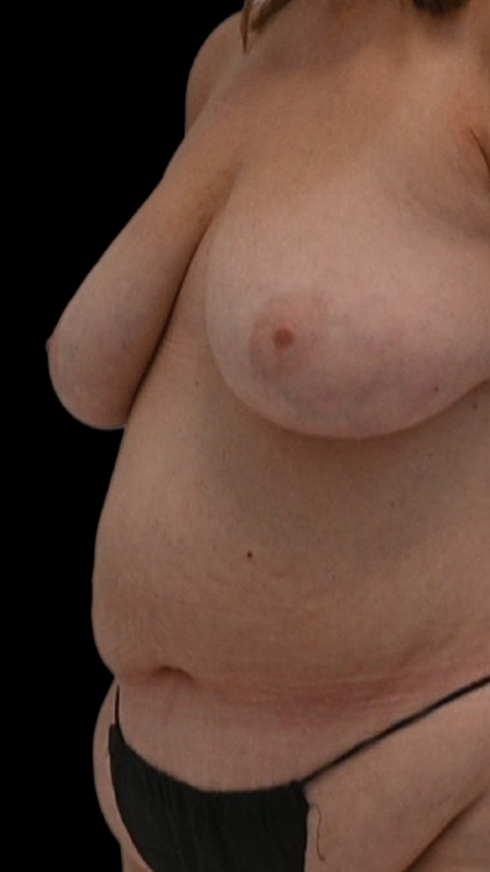 Nipple Reconstruction Before & After Image
