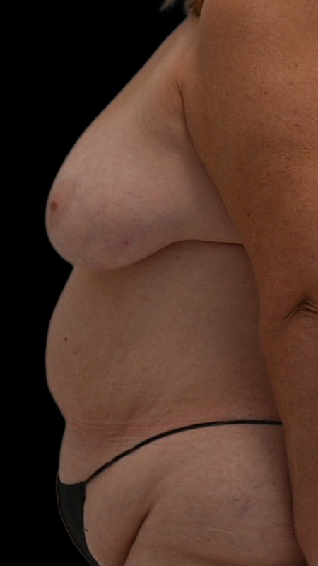 Nipple Reconstruction Before & After Image