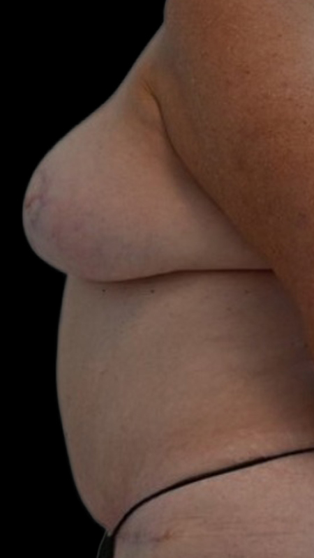 Nipple Reconstruction Before & After Image