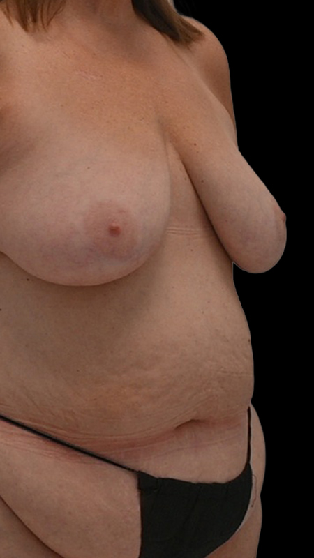 Nipple Reconstruction Before & After Image