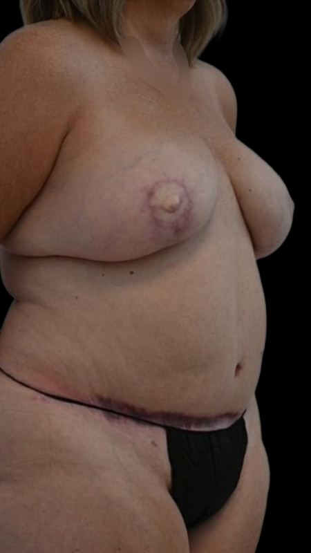 Nipple Reconstruction Before & After Image