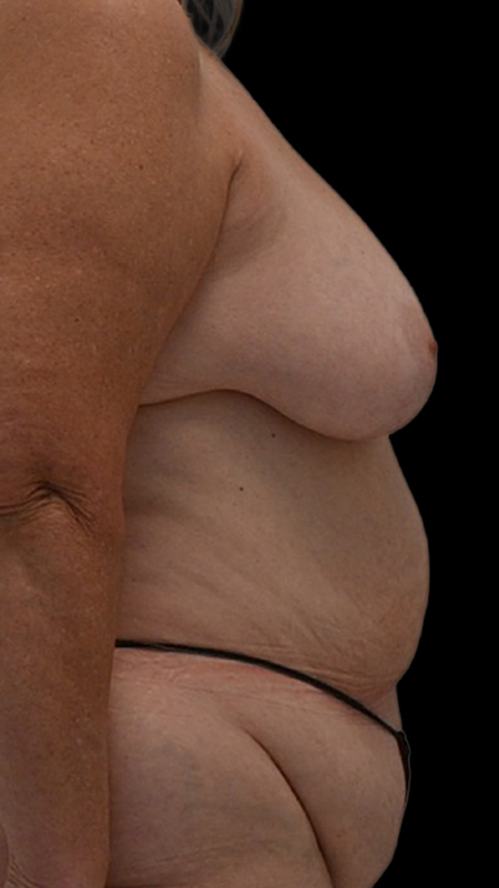 Nipple Reconstruction Before & After Image