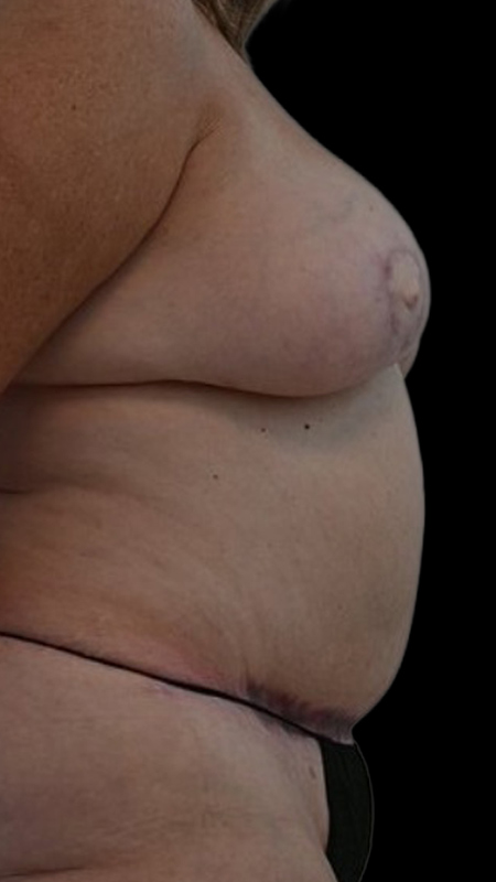 Nipple Reconstruction Before & After Image