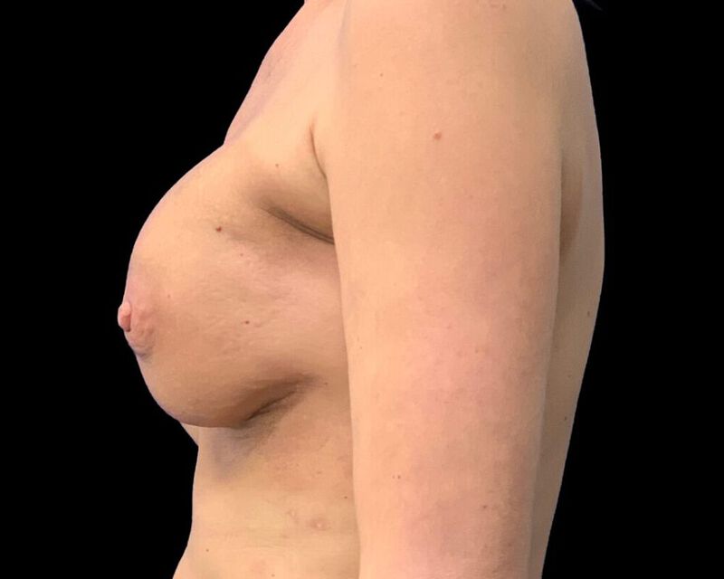 Nipple Sparing Reconstruction Before & After Image