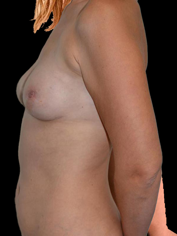 Nipple Sparing Reconstruction Before & After Image