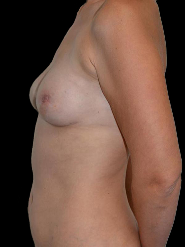 Nipple Sparing Reconstruction Before & After Image