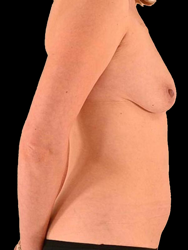 Nipple Sparing Reconstruction Before & After Image