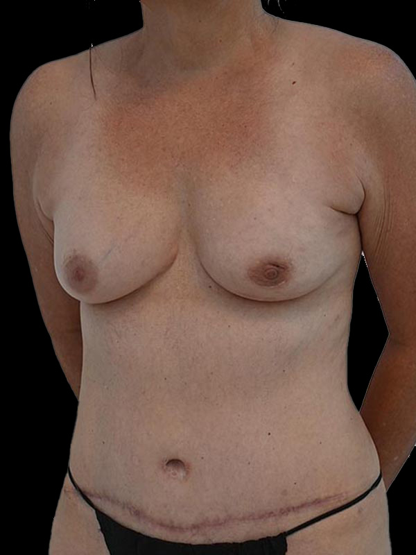 Nipple Sparing Reconstruction Before & After Image