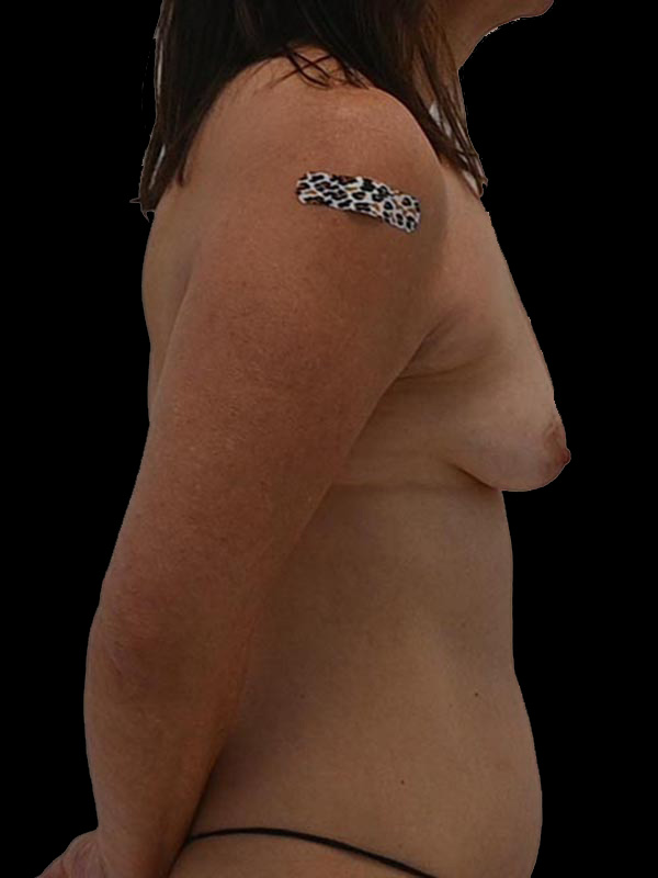 Nipple Sparing Reconstruction Before & After Image