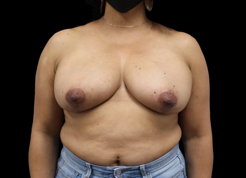 Oncoplastic Surgery Before & After Image