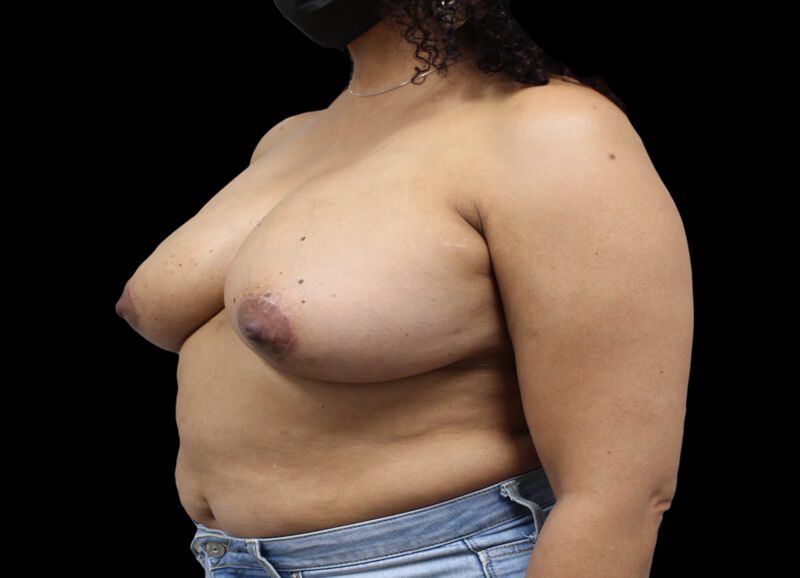 Oncoplastic Surgery Before & After Image