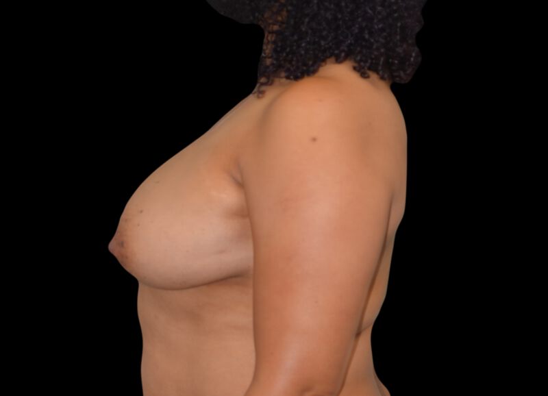 Oncoplastic Surgery Before & After Image