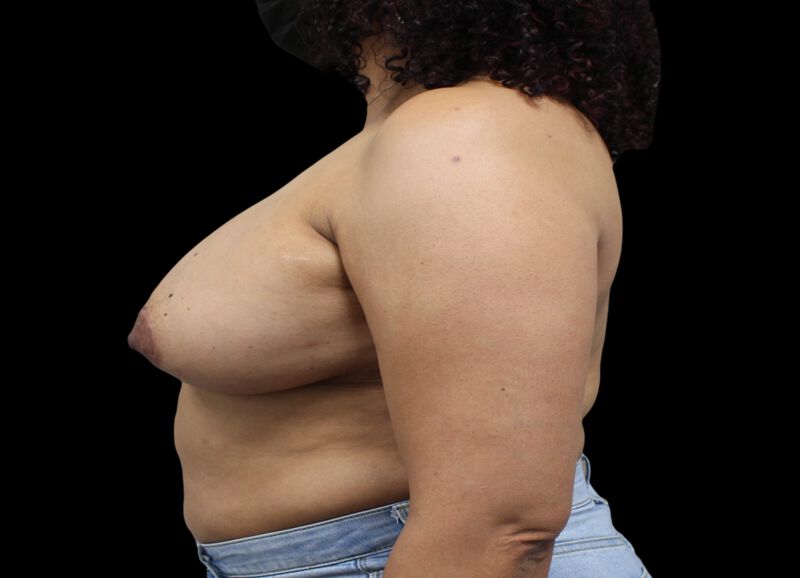 Oncoplastic Surgery Before & After Image