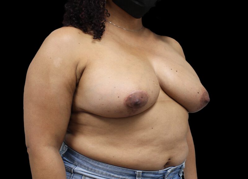 Oncoplastic Surgery Before & After Image