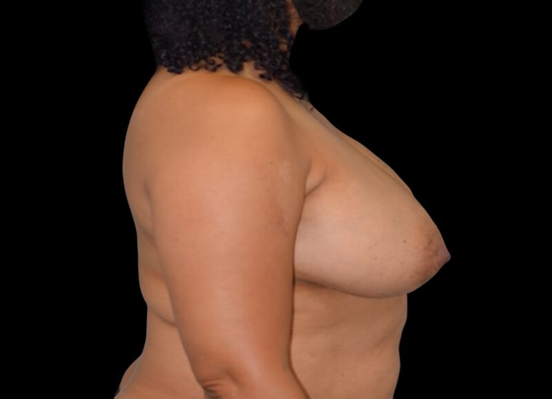 Oncoplastic Surgery Before & After Image