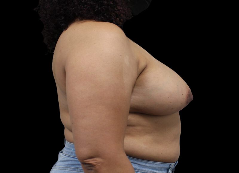 Oncoplastic Surgery Before & After Image